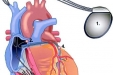 心脏再同步化治疗（CRT）