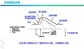 血栓弹力图