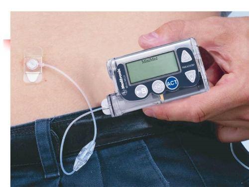 胰岛素泵帮助患者更好地控制血糖