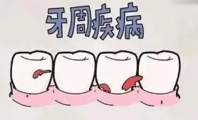 牙周炎对种植体的影响