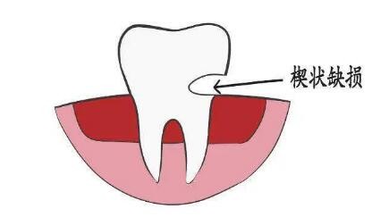 牙酸齿痛与楔状缺损