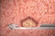 乳腺结节彩超引导真空辅助全自动乳腺微创旋切术