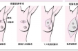 乳腺癌保乳手术
